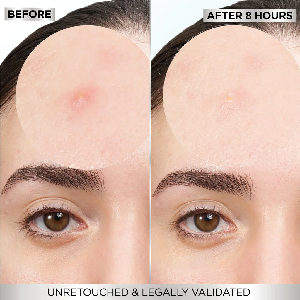 Garnier Skin Active Fast Clear Invisible Pimple Patch 8 Hours Hydrocolloid