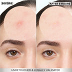 Garnier Skin Active Fast Clear Invisible Pimple Patch 8 Hours Hydrocolloid