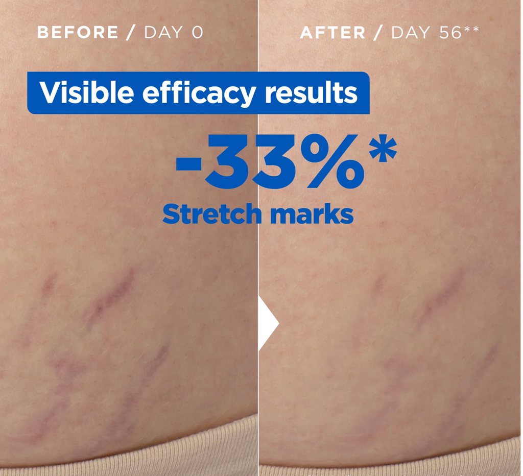 Mixa Anti Stretch Mark Oil - For Skin with Stretch Marks - With Omega 6 & 9