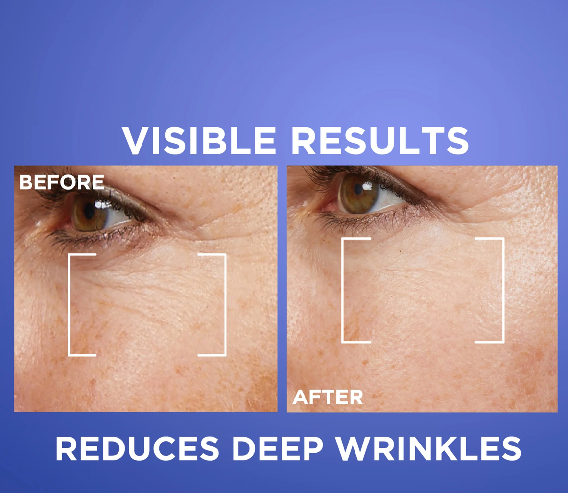 L'Oreal Paris Revitalift Retinol Night Serum For Face, With 0.2% Pure Retinol, Moisturizes Skin and Eliminates Deep Wrinkles, For All Skin Types